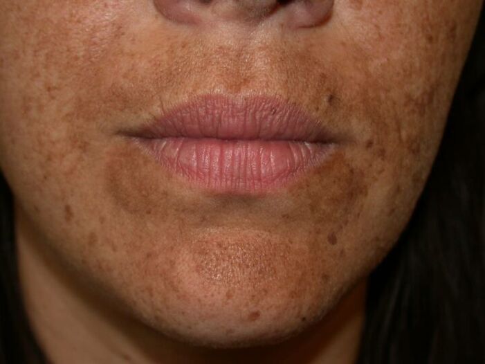 Pigmentové škvrny na tvári sú indikáciou pre laserový zákrok