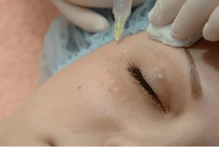 Mezoterapia