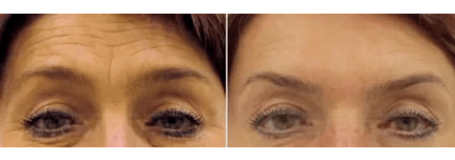 zariadenia na frakčné omladenie