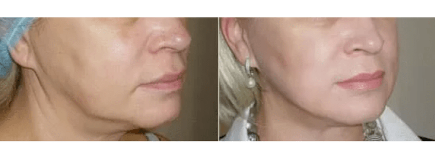 zotavenie po omladení pleti