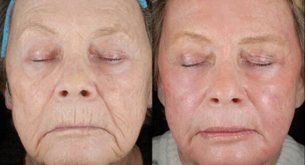 pred a po laserovej rejuvenizácii